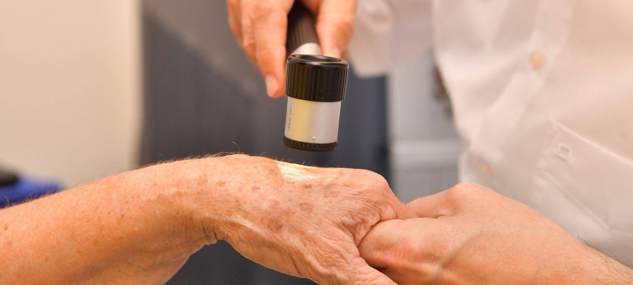 Dermatologe untersucht Altersflecken auf der Hand einer Frau